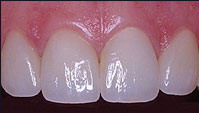 Kosmetinė odontologija - CEREC bemetalė keramika