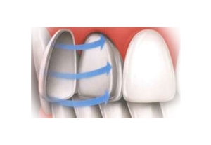 CEREC dental veneers
