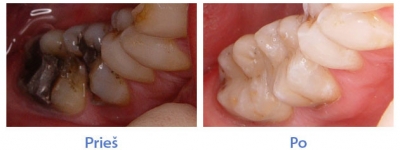 Indigenous dental restorations (CEREC) - photos