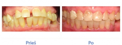 Dantų biprotrūzija - nuotraukos