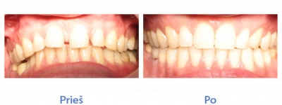 Viršutinio žandikaulio dantų tremos, diastema - nuotraukos