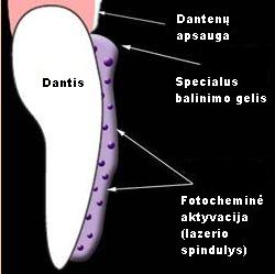 Dantų balinimo schema