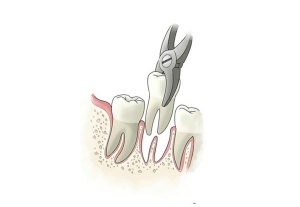 Dantų rovimas