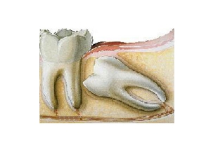 Protinių dantų rovimas